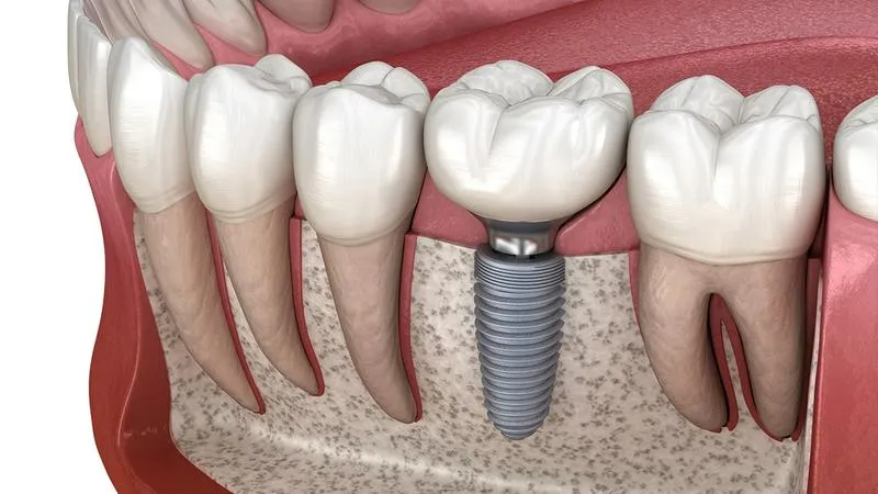 Nguyên nhân mất răng hàm dưới và cách để khắc phục chưa?