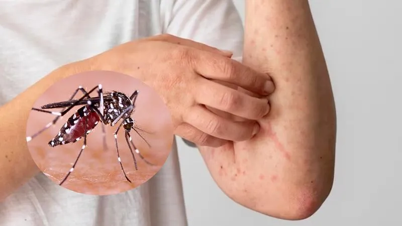 Nhận biết sự khác nhau giữa sốt virus và sốt xuất huyết