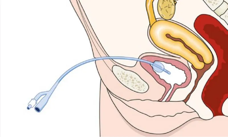 Như thế nào là dẫn lưu bàng quang trên xương mu?