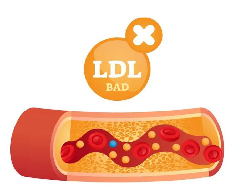 Những điều cần biết về chỉ số LDL cholesterol trong máu