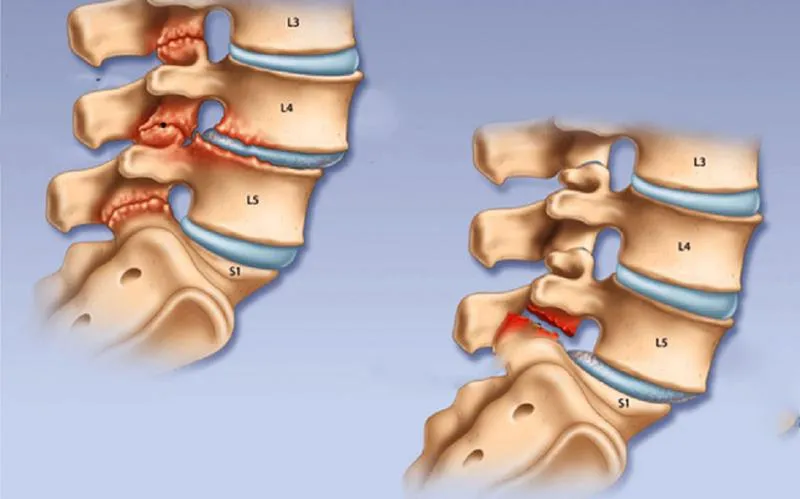 Những điều cần biết về hở eo đốt sống: Nguyên nhân, triệu chứng và cách điều trị bệnh