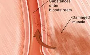 Những điều cần biết về hội chứng tiêu cơ vân cấp