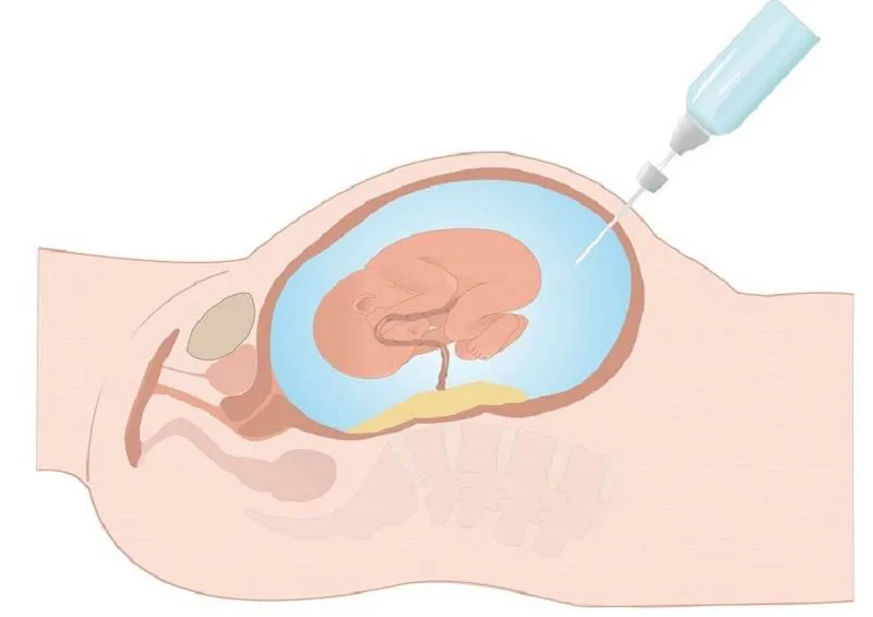 Những điều cần biết về xét nghiệm chẩn đoán sảy thai