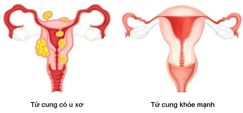 Nút mạch u xơ tử cung là gì? Ưu điểm của phương pháp điều trị này ra sao?