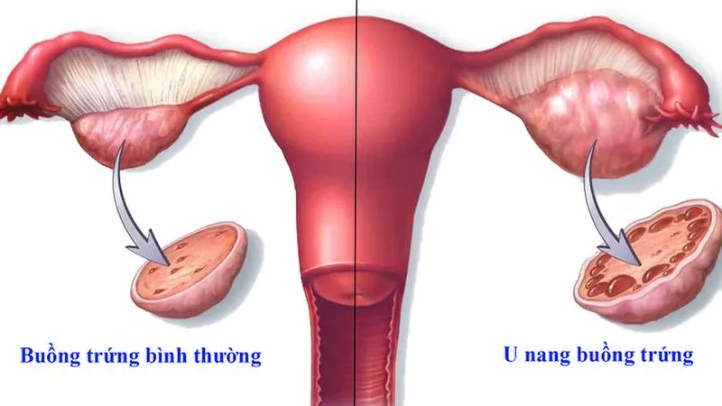 Phát hiện buồng trứng phải có nang 19mm có cần mổ không?