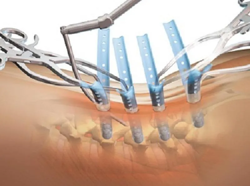 Phẫu thuật kết hợp xương bằng nẹp vít và những điều bạn cần biết