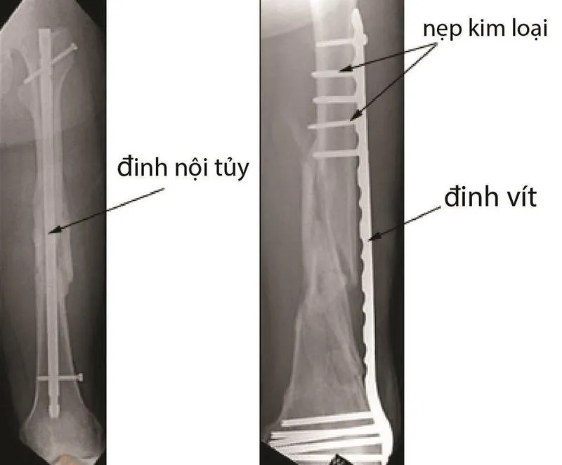 Phẫu thuật kết hợp xương là gì? Phẫu thuật kết hợp xương có mấy loại?