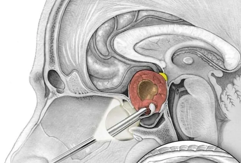 Phẫu thuật u tuyến yên và những điều cần biết