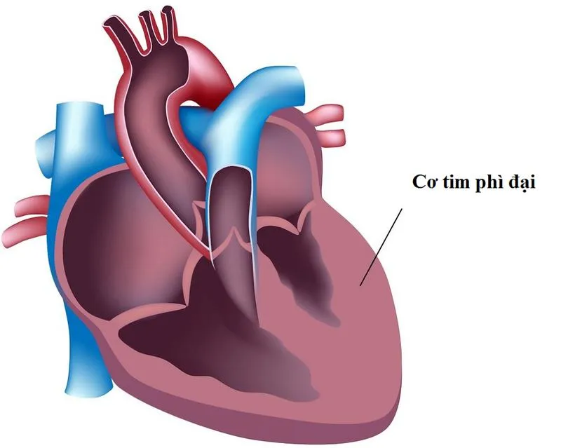 Phì đại tâm thất ở tim là gì? Nguyên nhân và dấu hiệu nhận biết bệnh thế nào?