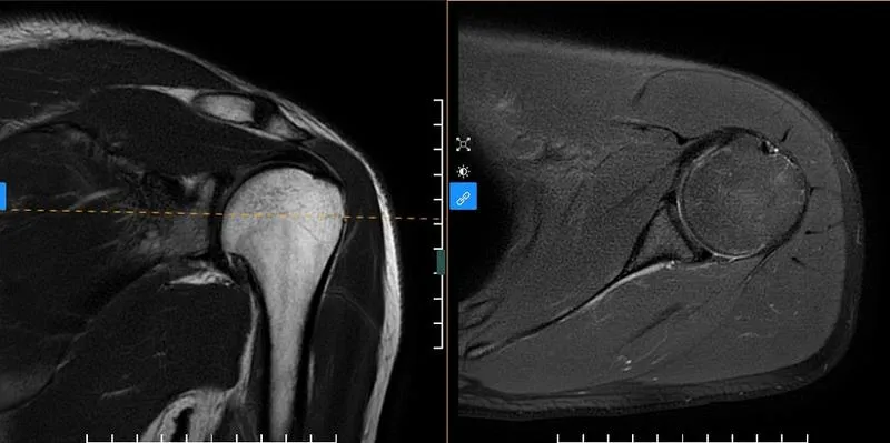 Phương pháp chụp MRI khớp vai là gì? Khi nào cần thực hiện chụp MRI khớp vai?