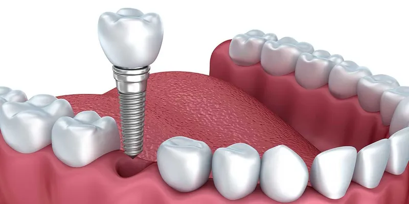 Răng số 7 là răng gì? Điều trị khi bị mất răng số 7 thế nào?