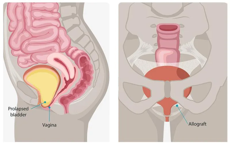 Sa bàng quang là bệnh gì? Nguyên nhân và cách điều trị