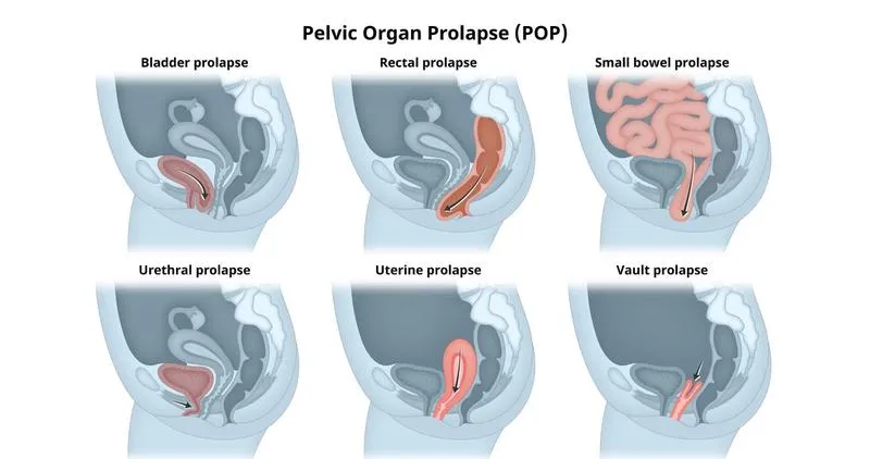 Sa bàng quang là bệnh gì? Nguyên nhân và cách điều trị