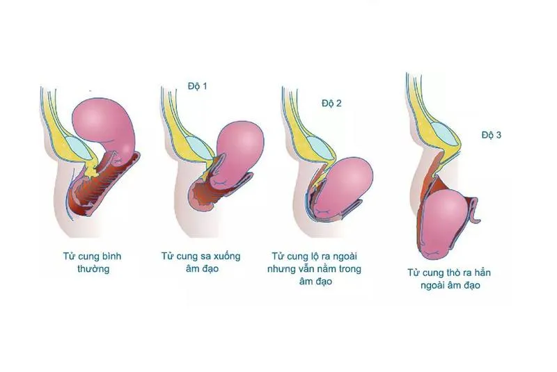 Sa tử cung độ 1 có mang thai được không? Có chữa được không?