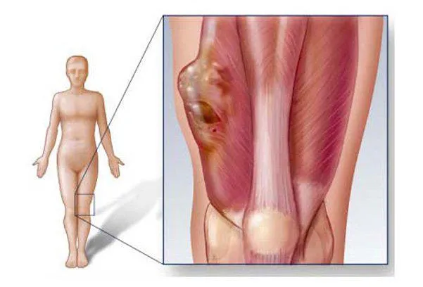 Sarcoma mô mềm sống được bao lâu và có phương pháp nào điều trị?