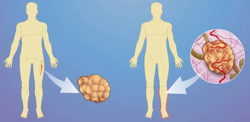 Sarcoma mô mềm sống được bao lâu và có phương pháp nào điều trị?