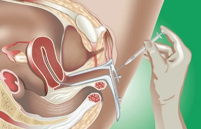 Sau bơm IUI bao lâu thì tinh trùng gặp trứng? Dấu hiệu có thai sau khi thực hiện IUI