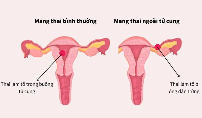 Sau khi đặt vòng tránh thai bị ra máu nhiều có bình thường không?