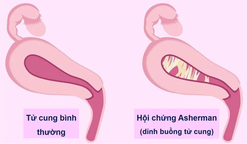 Siêu âm có phát hiện dính buồng tử cung không?