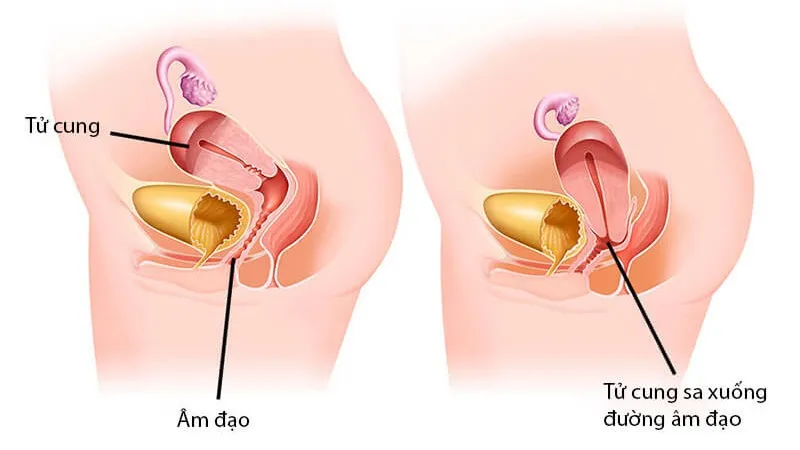 Siêu âm có phát hiện sa tử cung không?