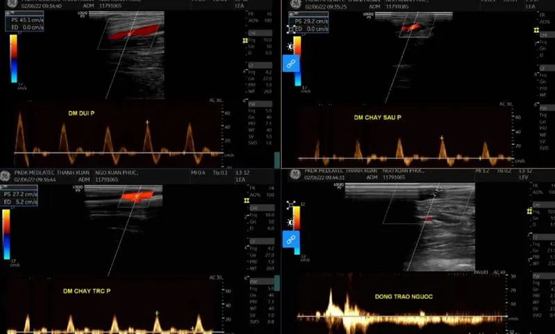 Siêu âm Duplex là gì? Có thể phát hiện được những bệnh gì?