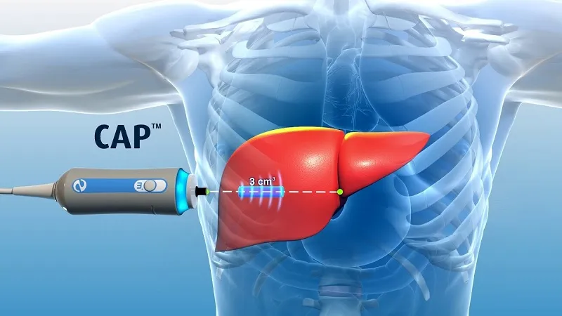 Siêu âm fibroscan là gì? Siêu âm fibroscan có tác dụng gì?