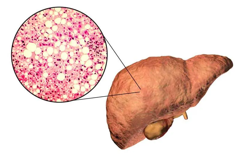 Siêu âm fibroscan là gì? Siêu âm fibroscan có tác dụng gì?