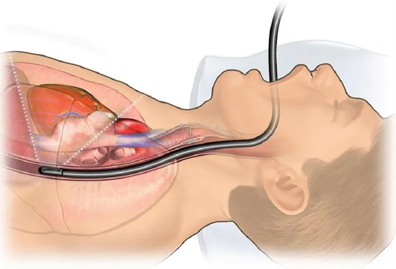 Siêu âm tim qua thực quản là gì? Những điều cần biết về phương pháp này