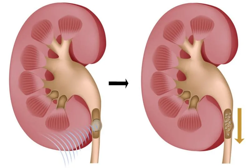 Sỏi niệu đạo ở nam: Nguyên nhân, triệu chứng và phương hướng điều trị