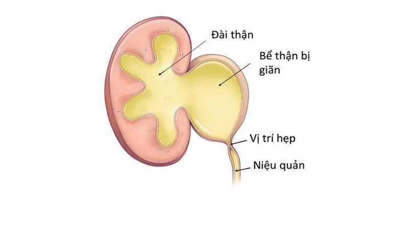 Sỏi niệu quản đoạn sát thành bàng quang điều trị như thế nào?