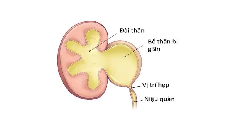 Sỏi niệu quản nội thành bàng quang là gì? Cách điều trị