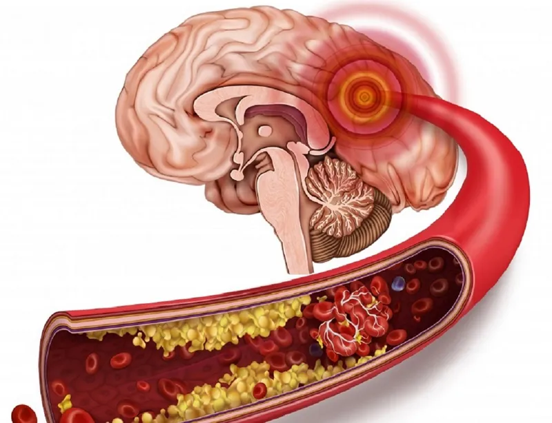 Tắc mạch máu não có nguy hiểm không? Các biện pháp phòng ngừa tắc bệnh