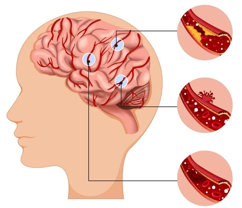 Tắc mạch máu não có nguy hiểm không? Các biện pháp phòng ngừa tắc bệnh