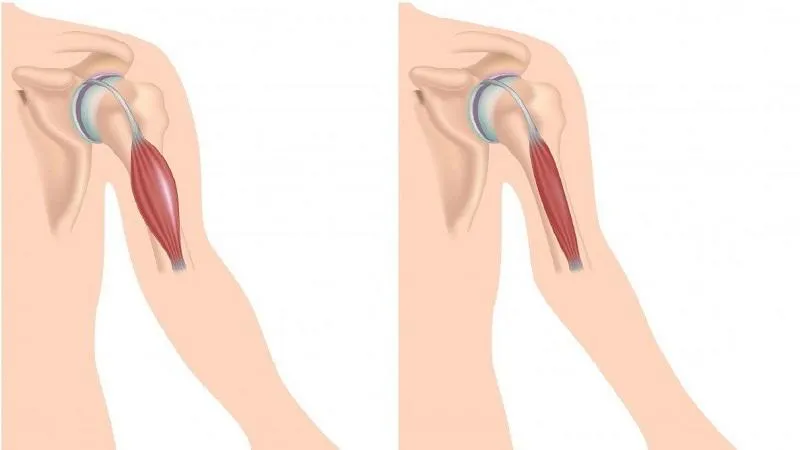 Teo cơ sau chấn thương liệu có khả năng phục hồi?