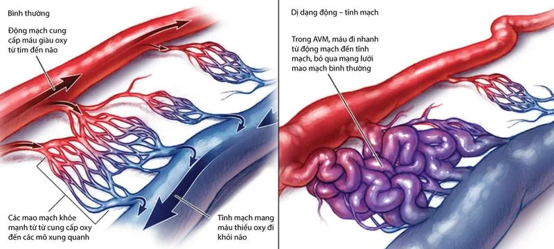 Thông động tĩnh mạch là gì? Nguyên nhân, triệu chứng, phương pháp chẩn đoán và điều trị