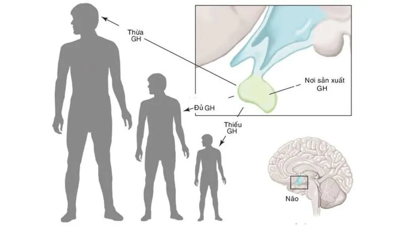 Thừa hormone tăng trưởng: Nguyên nhân, triệu chứng và cách điều trị