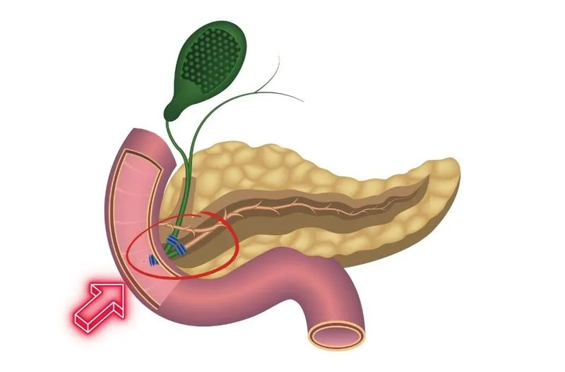 Tìm hiểu chi tiết về rối loạn cơ vòng Oddi