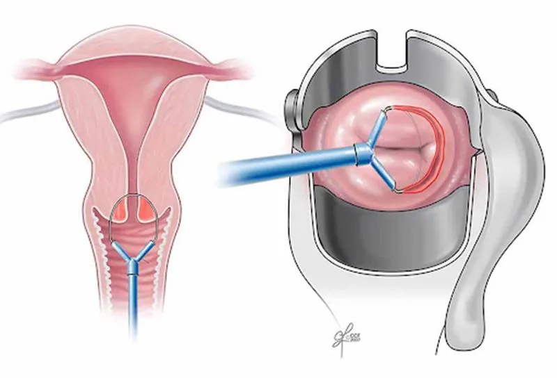 Tìm hiểu chi tiết về thủ thuật khoét chóp cổ tử cung