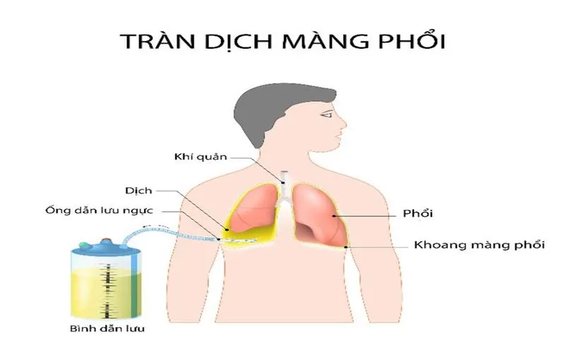 Tìm hiểu về kỹ thuật chọc dịch màng phổi