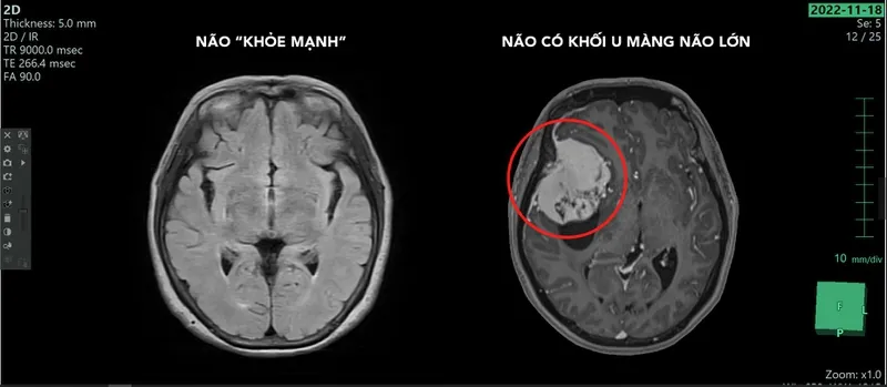 Tìm hiểu về phương pháp phẫu thuật u màng não lỗ chẩm