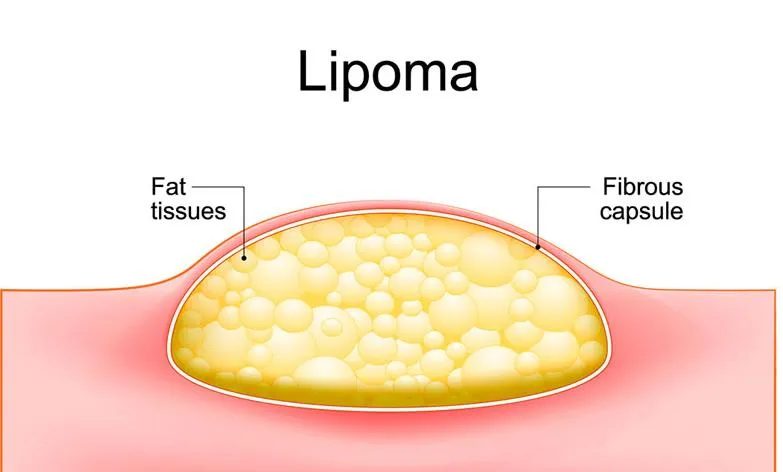 Tìm hiểu về u mỡ lành tính và cách điều trị u mỡ lành tính