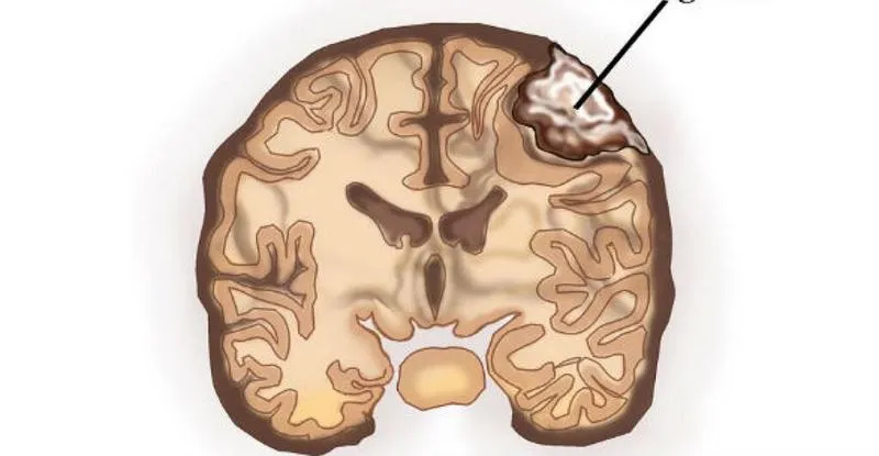 Tìm hiểu về vai trò của chụp MRI u màng não trong chẩn đoán bệnh