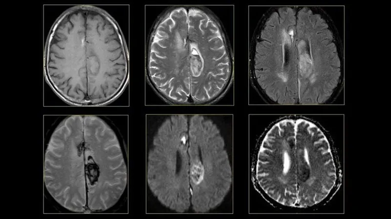 Tìm hiểu về vai trò của chụp MRI u màng não trong chẩn đoán bệnh