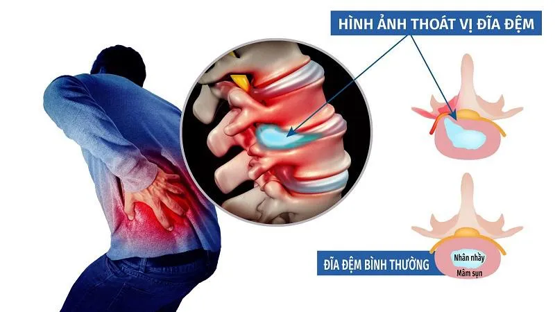 Tổn thương tủy sống có thể chữa được không?