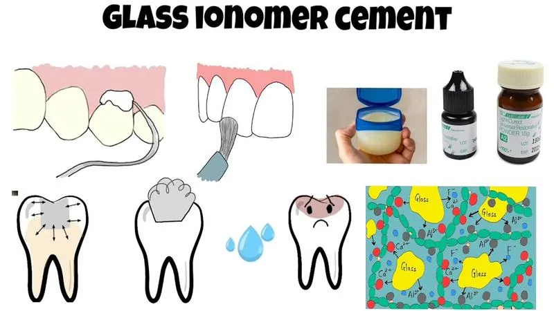 Trám răng bằng công nghệ Glass Ionomer Cement