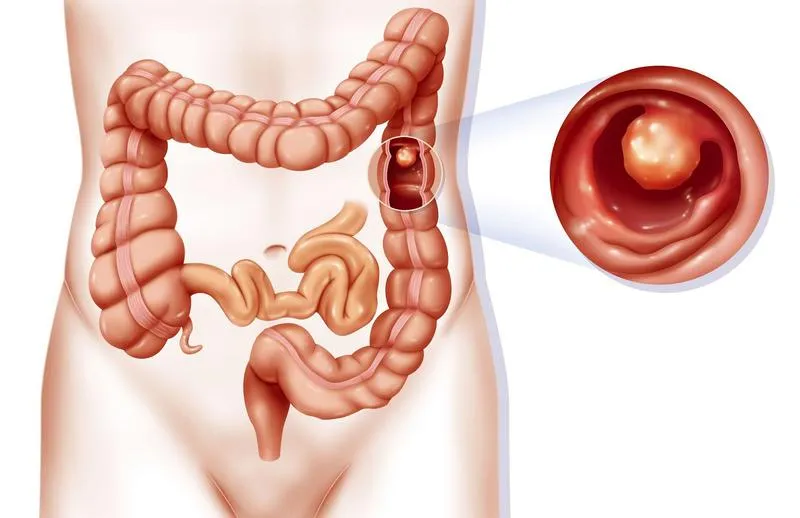 Trẻ sơ sinh đi ngoài có nhầy máu có sao không?