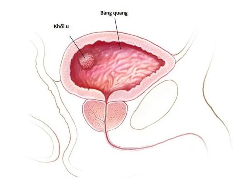 U bàng quang lành tính: Khái niệm, phân loại, triệu chứng và mức độ nguy hiểm