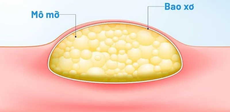 U đại tràng lành tính: Phân loại, chẩn đoán và điều trị