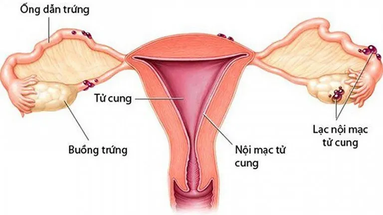 U nang buồng trứng có thai được không?