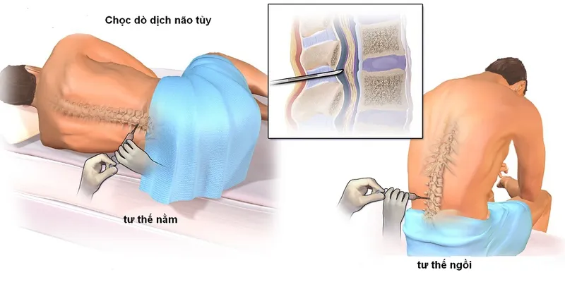 Vai trò của dịch não tủy là gì? Mục đích xét nghiệm dịch não tủy